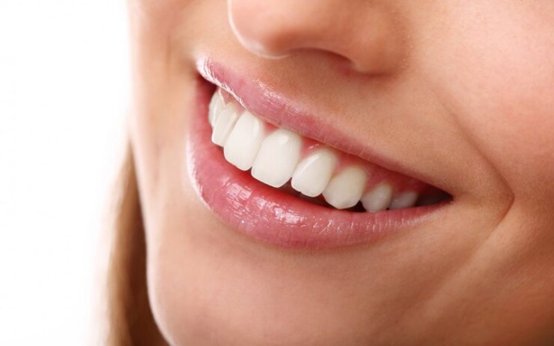 Dental Veneers